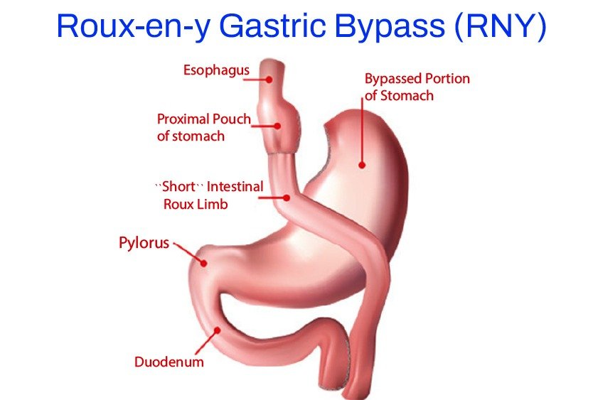 roue_en_y_gastric_by_pass_in_turkey