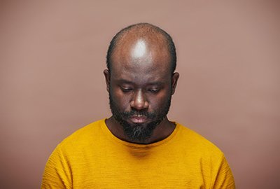 sad_bald_man-before-afro_hair_transplant_in_turkey