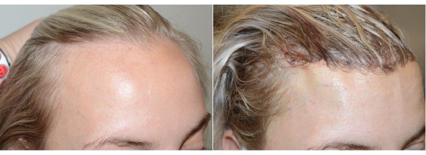 scarring_after_forehead_reduction_in_turkey