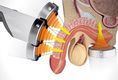 shockwave_therapy_for_ED_in_Turkey