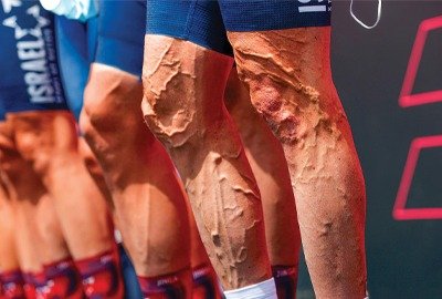 skin_changes_before_varicose_veins_in_turkey