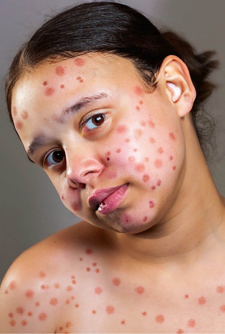 skin_infection_after_morpheus8_in_turkey