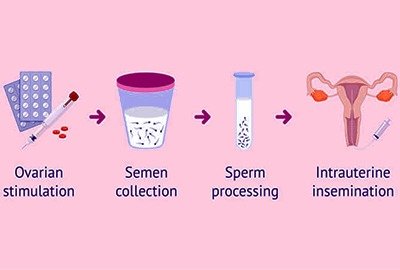 sperm_preparation_for_iui_in_turkey