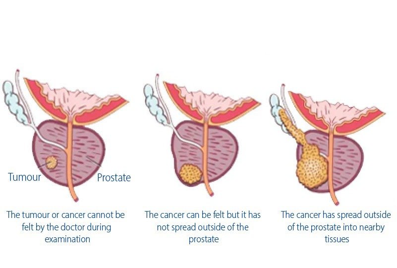 stages_of_prostate_cancer_for_prostate_cancer_treatment_in_turkey (2)