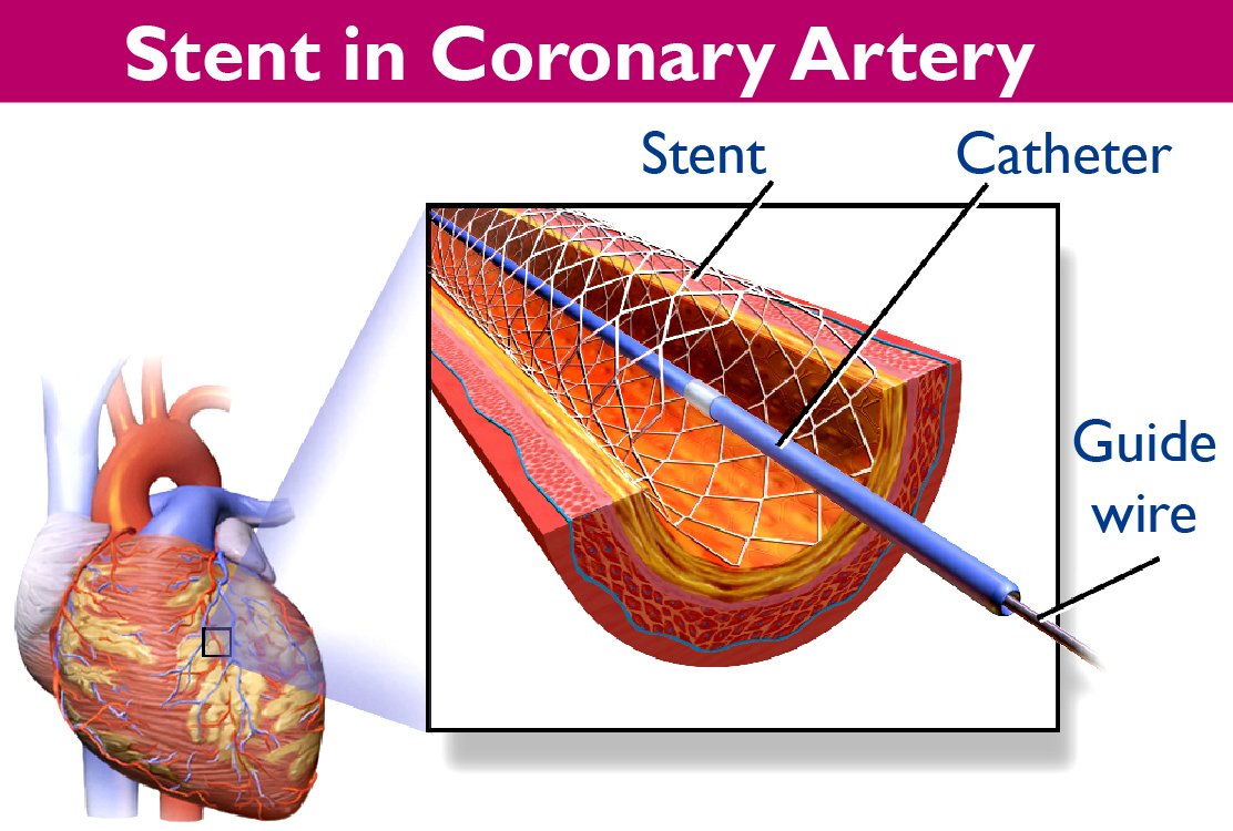 stent-for-angioplasty-in-turkey