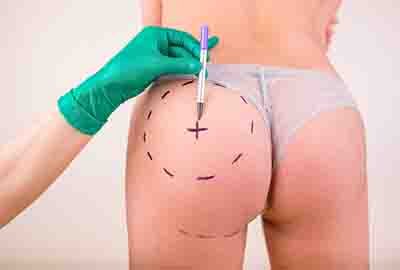 surgeon_customizing_butt_before_liquid_lipo