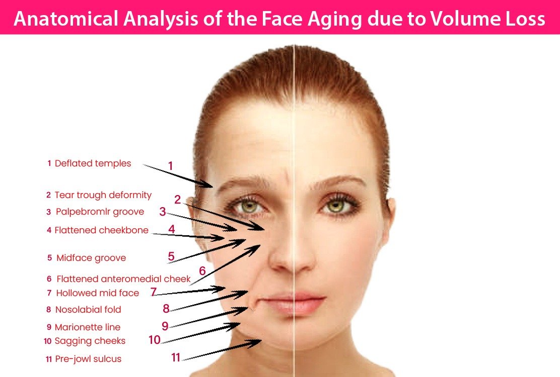 symptoms_of_volume_loss_for_face_fat_transfer_in_turkey