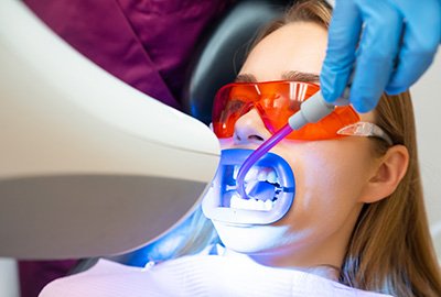teeth_whitening_for_hollywood_smile_in_turkey