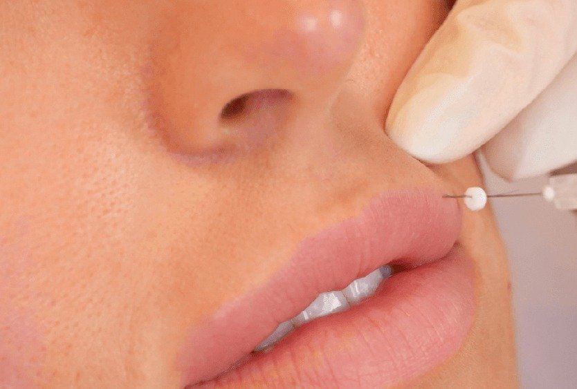 thread_lift_vs_lip_lift_in_turkey