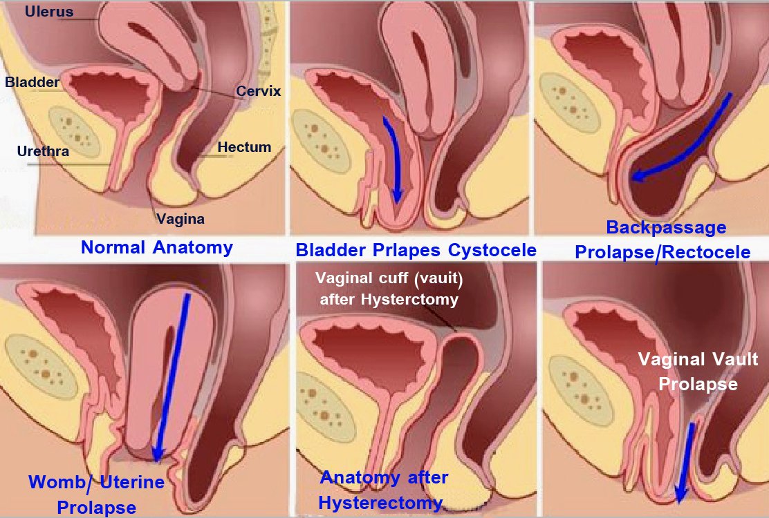 types-of-pelvic-prolapse-for-Pelvic-prolapse-repair-in-Turkey