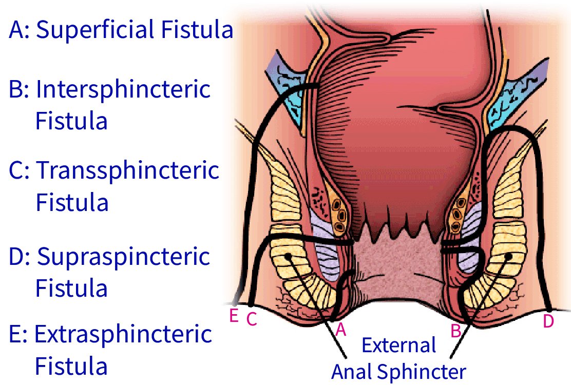 TYPES_OF_FISTULAS _for_Anal_Fistula_Surgery_in_Turkey