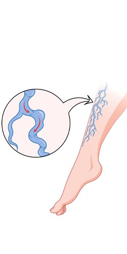 varicose_vein_treatment_in_turkey_recurrence
