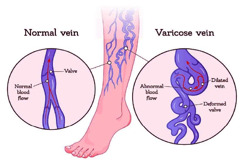 varicose_veins_depiction_in_vector_before_surgery_in_turkey