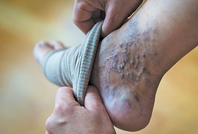 varicose_veins_in_turkey_early_detection