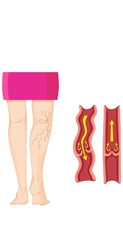 varicose_veins_in_turkey_vector