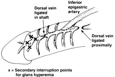 vascular_surgery_for_erectile_dysfunctionin_turkey_treatment