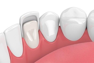 vecctor_showing_veneers