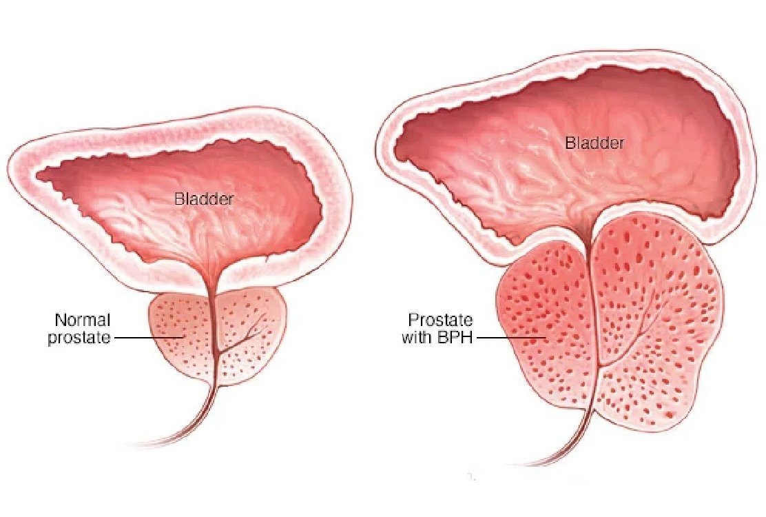 vector_illustarting_BPH_symptoms