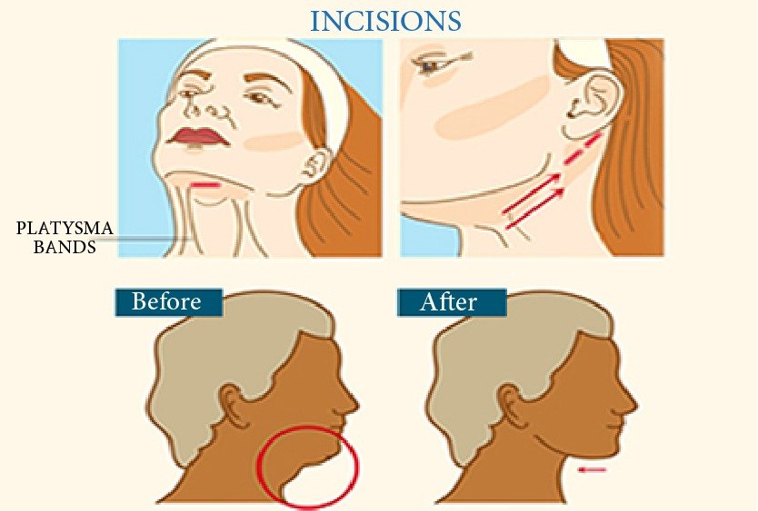 vector_illustarting_neck_lift_in_turkey