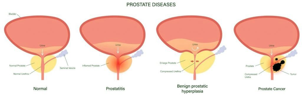 vector_illustarting_prostate_illness_symptoms