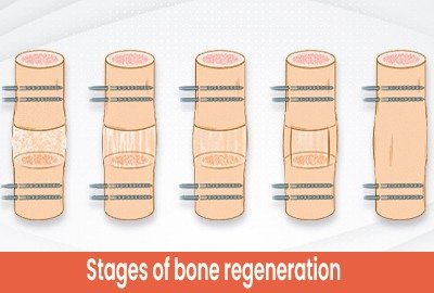vector_illustrating_bone_growth_procedure