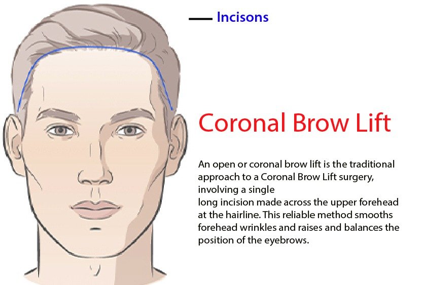 vector_illustrating_coronal_brow_lift_in_turkey (2)