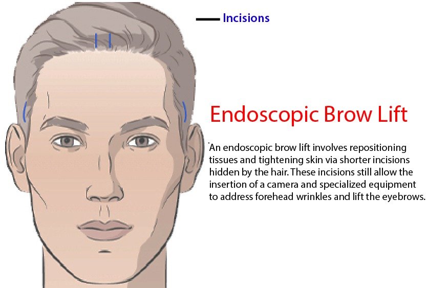 vector_illustrating_endoscopic_brow_lift_in_turkey