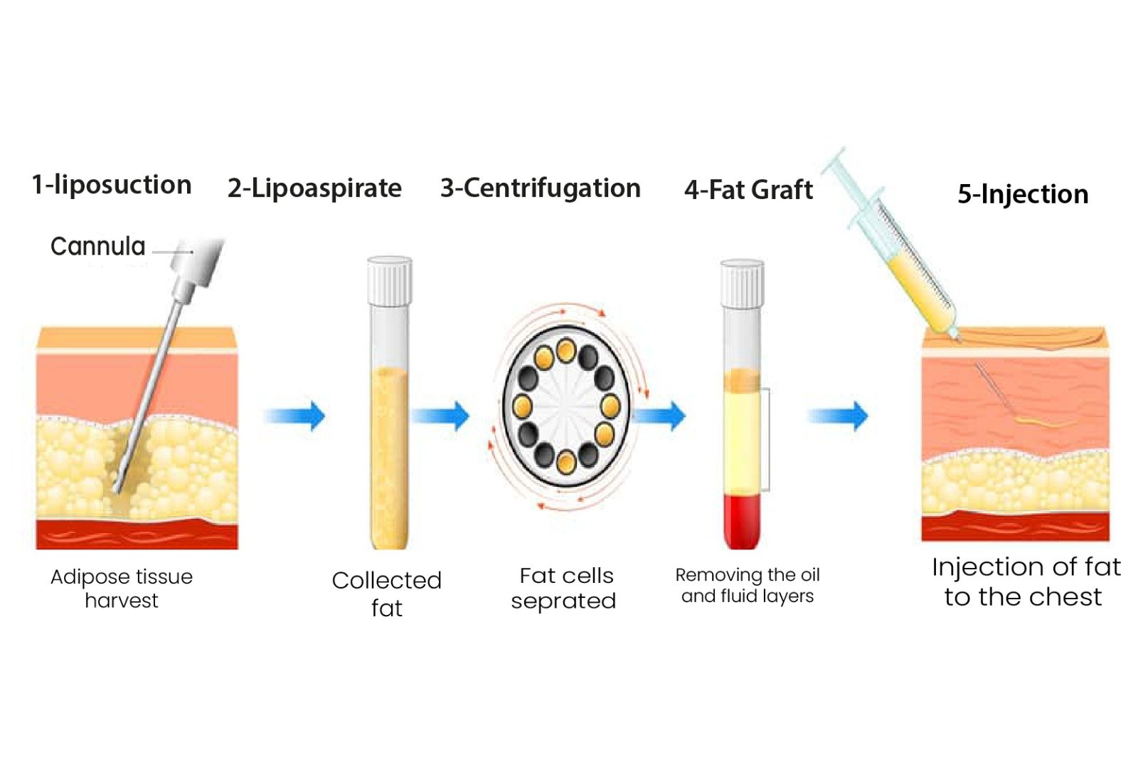vector_illustrating_fat_transfer_pec_augmentation_in_turkey