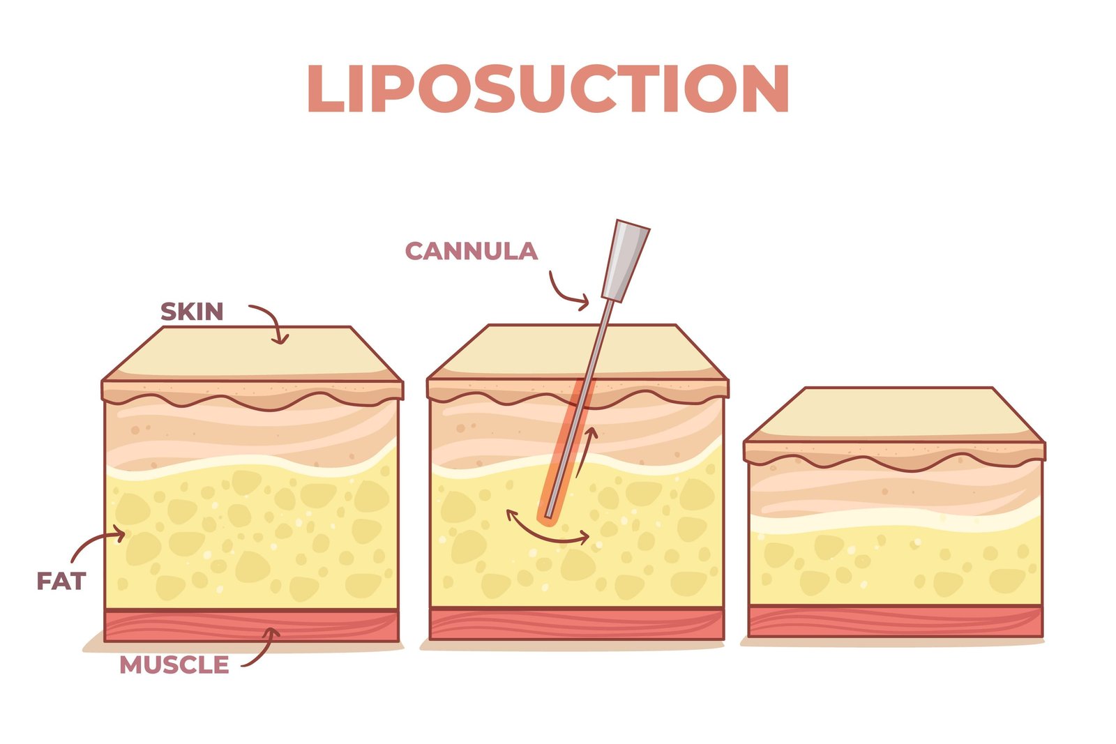 vector_illustrating_liposuction_in_turkey_procedure