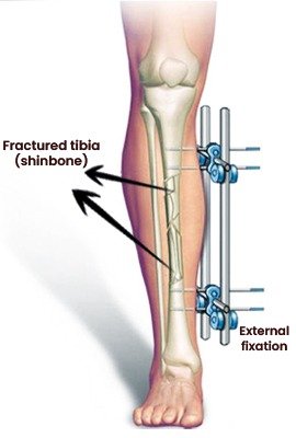 vector_illustrating_lon_height_lenghtening_surgery
