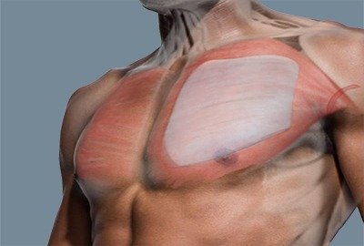 vector_illustrating_male_pec_implant_in_turkey