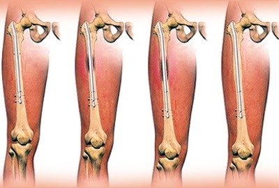 vector_illustrating_precice_limb_lengthening_surgery