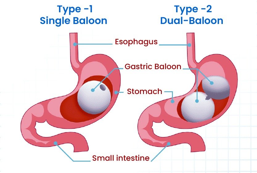 vector_illustrating_single_vs_dual_gastric_balloon_in_turkey