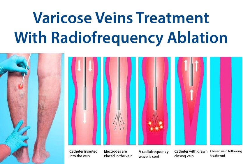 vector_illustrating_varicose_vein_treatment_in_turkey_with_radiofrequency_ablation