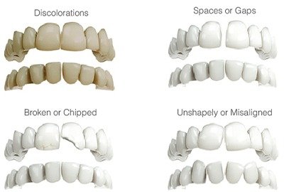 vector_illustrating_what_veneers_can_do