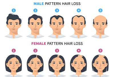vector_illustratingmale_and_female_pattern_hair_loss_for_hair_transplant_in_turkey