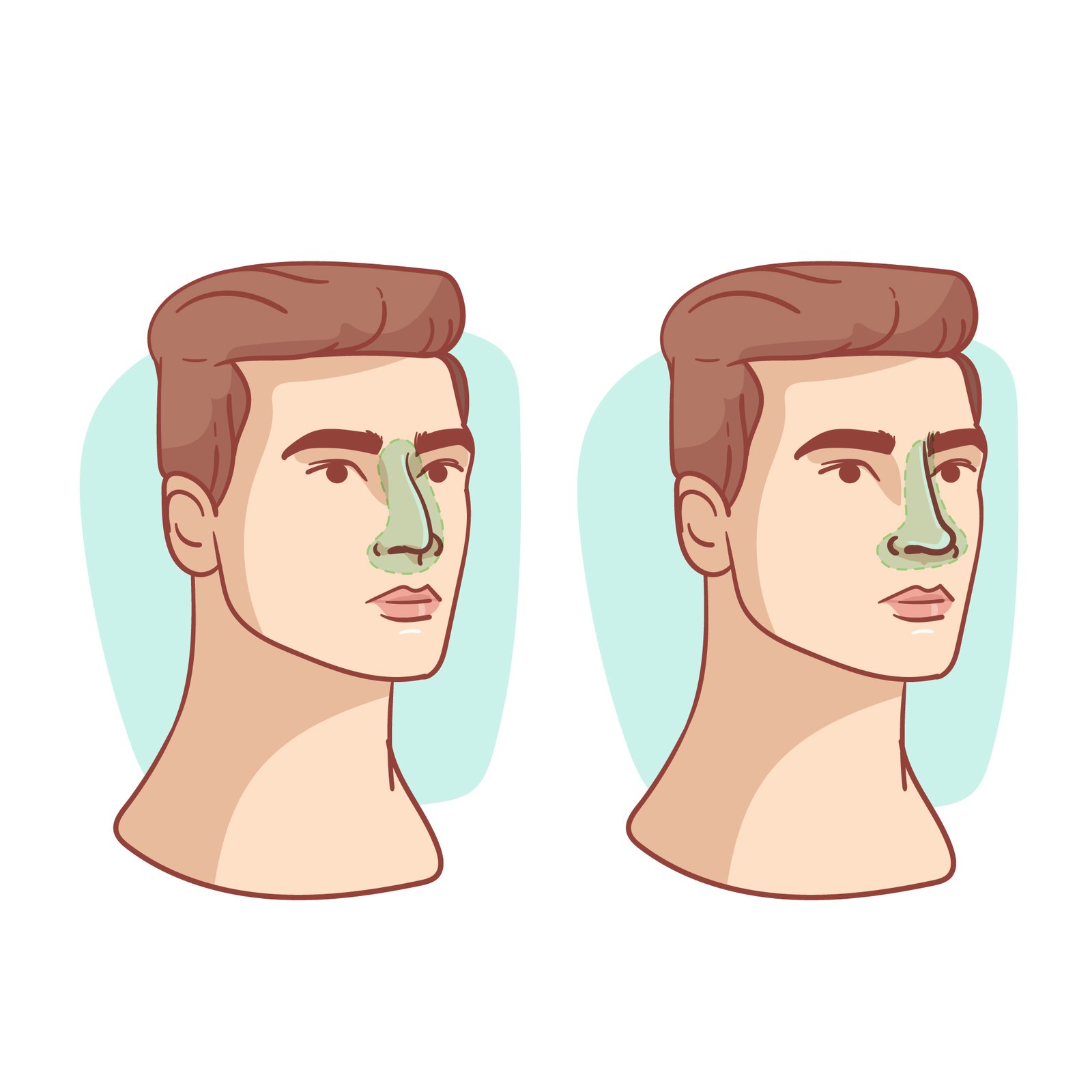 vector_of_male_rhinoplasty_in_turkey