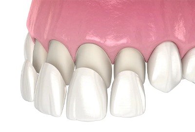 /upload/galeri/vector_show_casing_veneers_20240604132637.jpeg