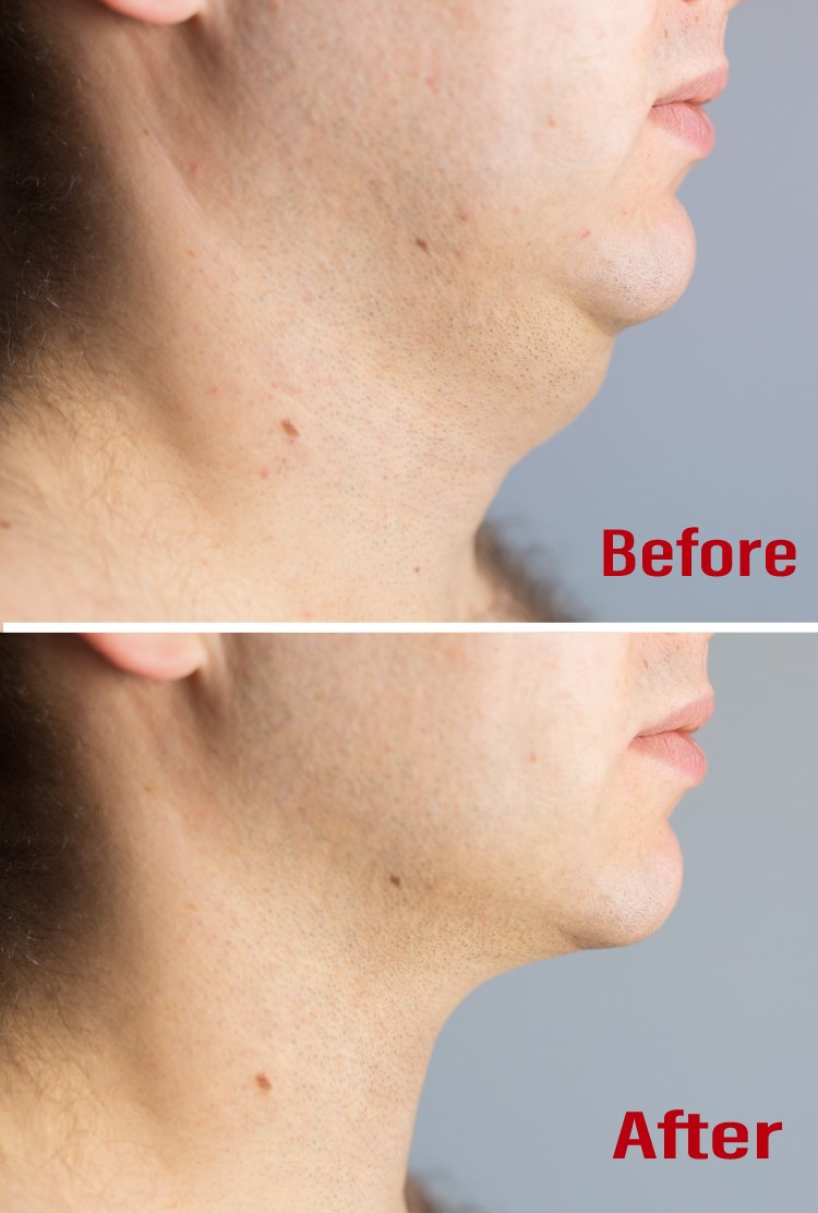 woman-with-double-chin-before-chin-liposuction-in-turkey