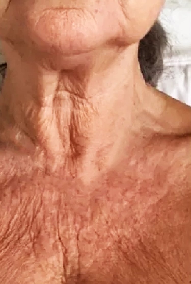 woman_ needing _decolletage _rejuvenation _in _turkey