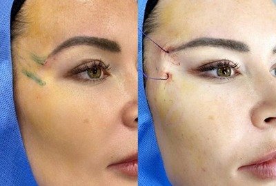 woman_before_and_after_fox_lift_surgery