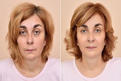 woman_before_and_after_receiving_non_invasive_laser_facelift_in_turkey