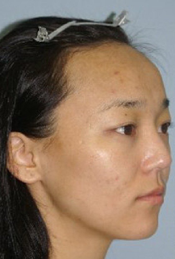 woman_before_forhead_reduction_in_turkey