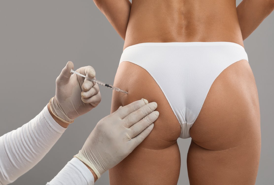 woman_for_hip_dip_correction_in_turkey_with_fillers