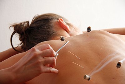 woman_receiving_acupunture_post_labiaplasty_in_turkey