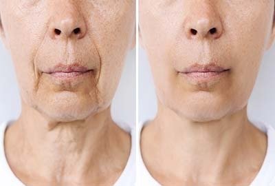 woman_with_before_and_after-non_invasive-results