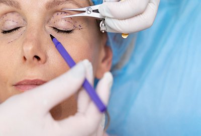 woman_with_blepharoplasty