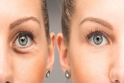 woman_with_blepharoplasty_results