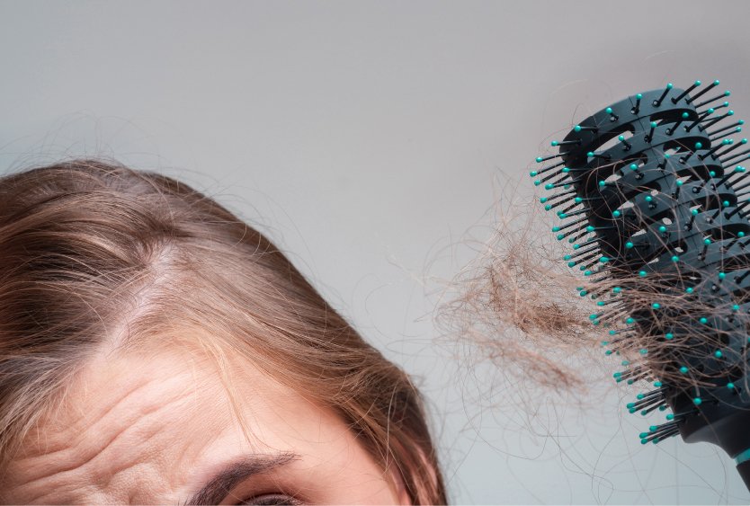 woman_with_hairloss_after_forehead_reduction_in_turkey