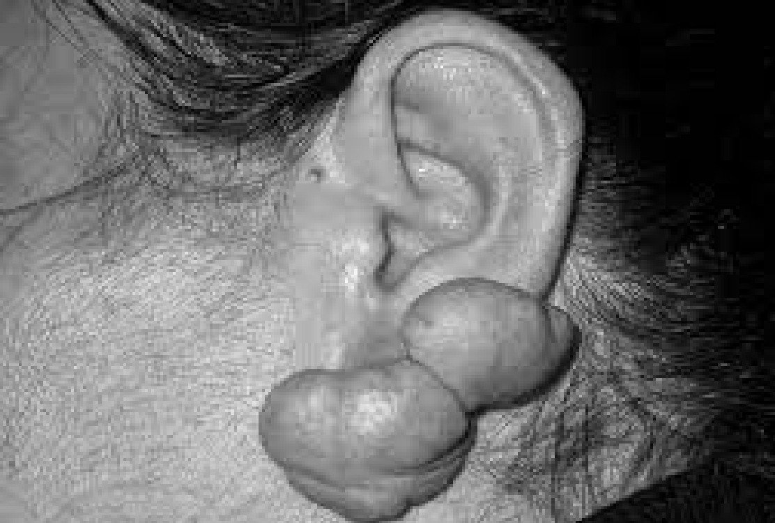woman_with_keloid_on_ear_before_keloid_in_turkey_treatment
